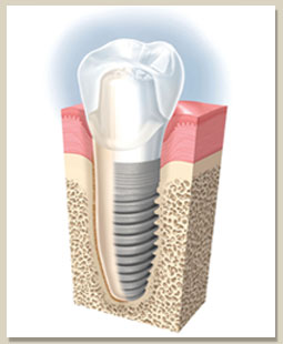 Dental Implant in Thailand by Bangkok Dental Image